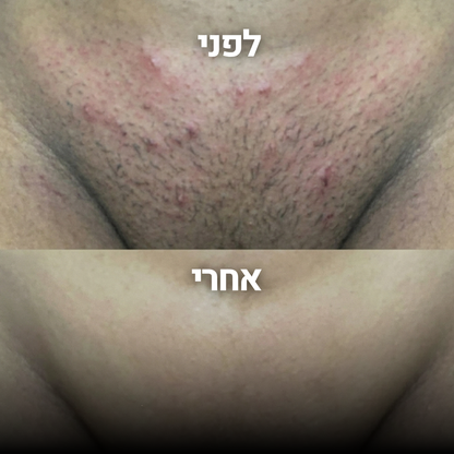 מסיר שיער | RENNE